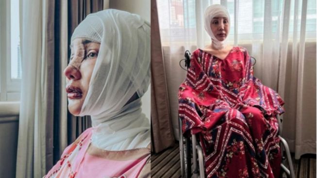 Ngilu! Jahitan Lucinta Luna Sobek Gara-gara Joget