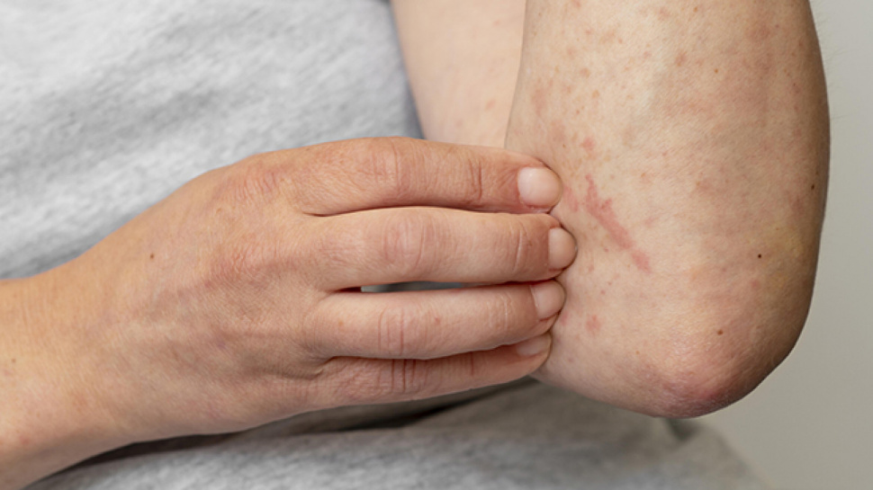 Relief and Treatment for Eczema: Tips to Reduce Symptoms and Manage the Condition