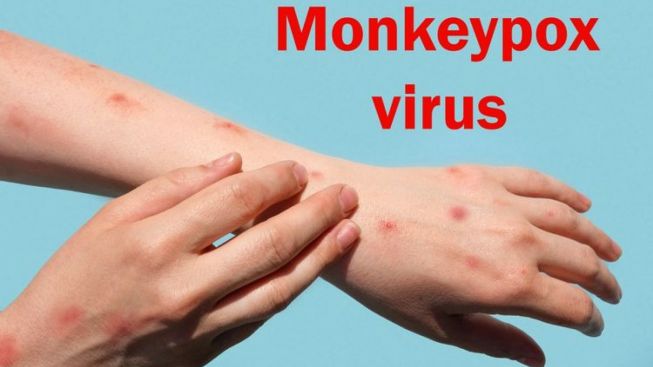 Kenali Penyakit Cacar Monyet, Begini Gejala dan Cara Pencegahannya