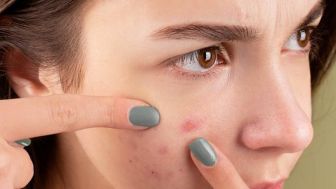Fakta Menarik tentang Jerawat, Banyak Diderita Remaja