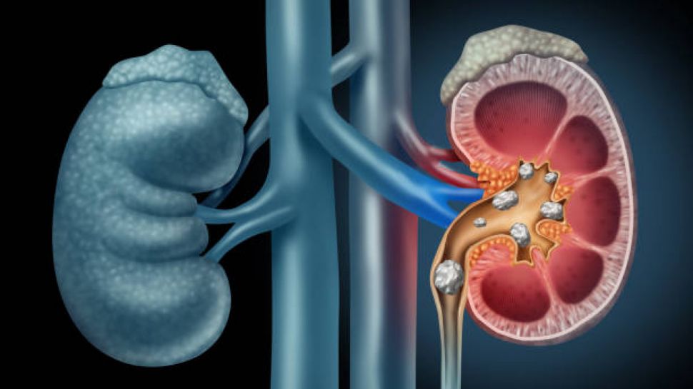 Kamu Wajib Tahu Ini Perbedaan Gagal Ginjal Akut Dan Gagal Ginjal Kronis