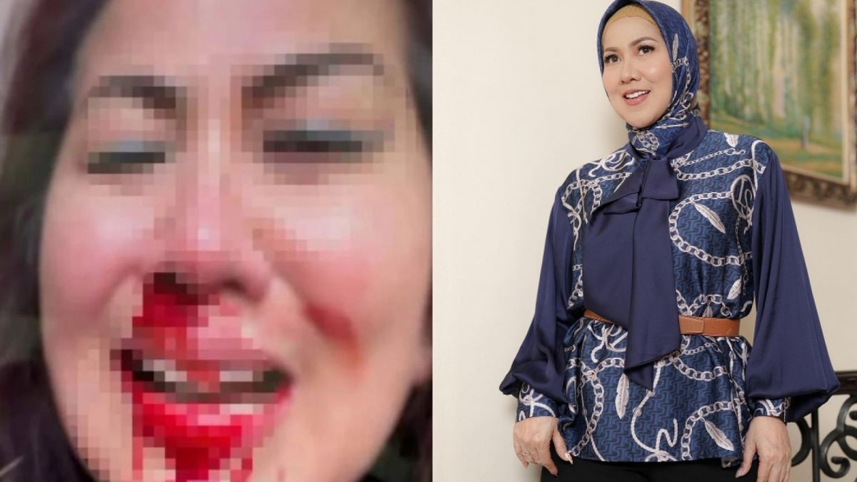 Foto Wajah Venna Melinda Berlumuran Darah Beredar Di Media Sosial Bukti Kdrt Ferry Irawan