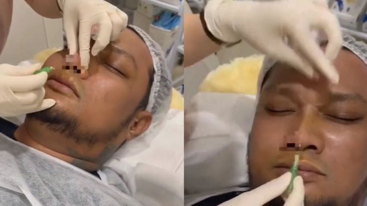 Foto kolase Virgoun operasi hidung [TikTok @memangharusgalau]