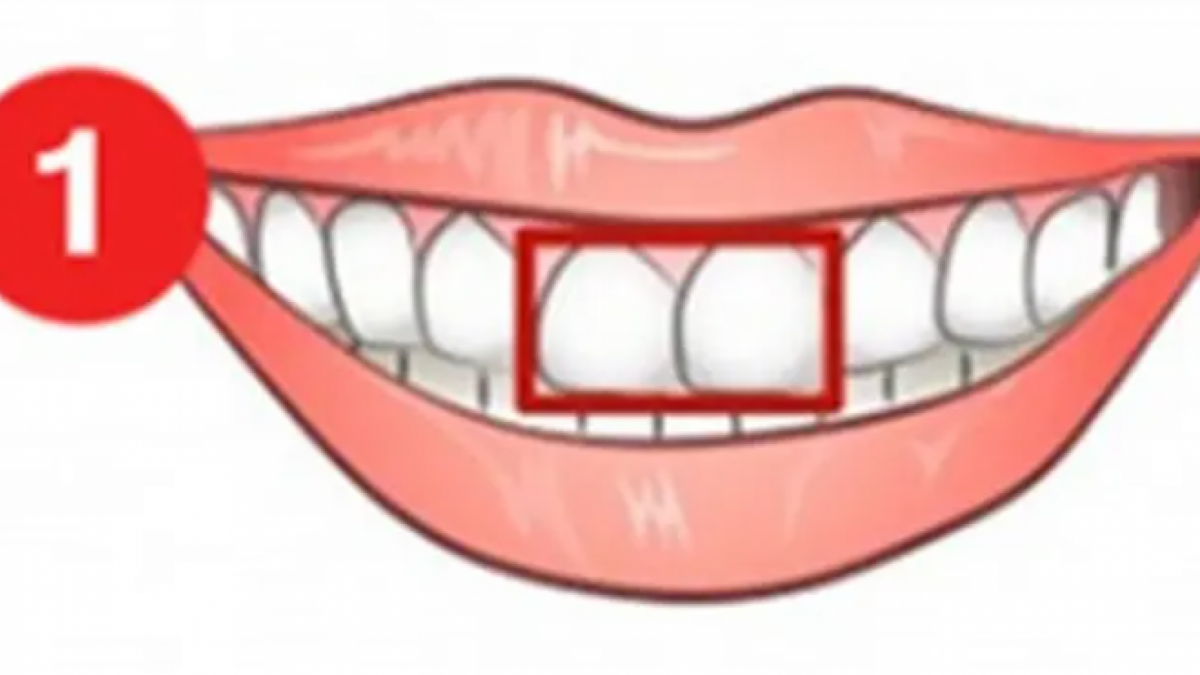 Gigi persegi panjang