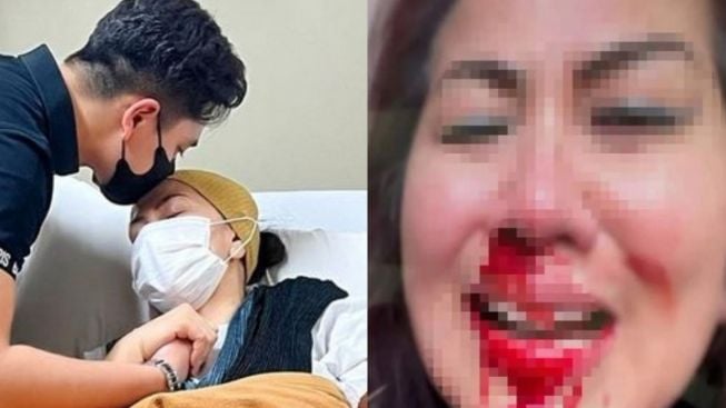 Kondisi Terkini Venna Melinda: Terbaring Lemas, Hidung Berdarah-darah, dan Kesakitan di Tulang Rusuk