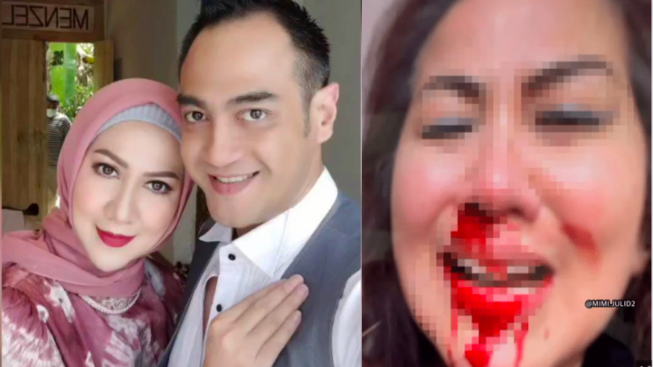 Ferry Irawan Awalnya Ngaku Benturkan Jidat ke Hidung Venna Melinda Hingga Berdarah, Tapi Kini Malah Bantah Aniaya Sang Istri