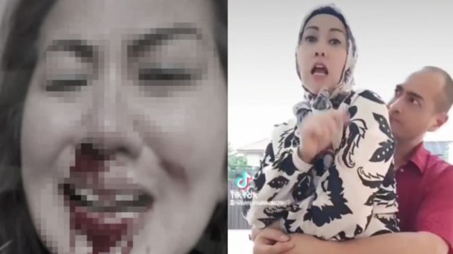 Bukti Ini Ungkap Fakta Sesungguhnya Soal Darah di Hidung Venna Melinda, Benar Mimisan?