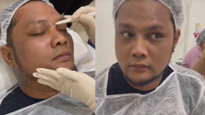 Buang Citra Dekil, Virgoun Jalani Perawatan Wajah hingga Operasi Hidung