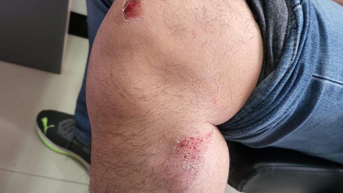 Luka Agus Hartono diduga penyiksaan terjadi saat pemeriksaan oleh Kejati Jateng. [Dok. Semarang.suara.com]