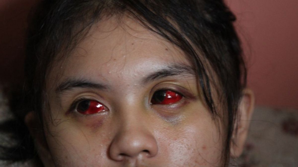 Superter Aremania Cahayu Nur Dewata, satu dari ratusan korban tragedi Kanjuruhan yang mengalami mata merah akibat terkena gas air mata dari polisi. [ANTARA FOTO/Ari Bowo Sucipto/wsj]