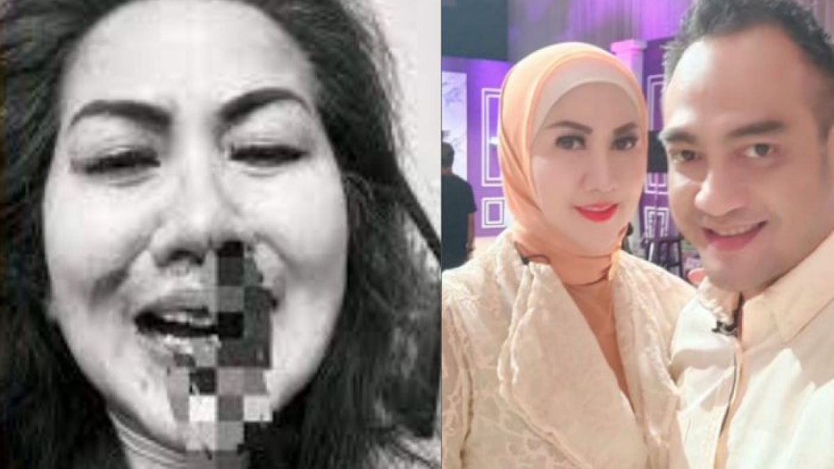 Hidung Venna Melinda berlumuran darah atas kejadian KDRT yang menimpanya dengan Ferry Irawan [Instagram/@vennamelindareal]