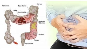 Kanker Usus Bisa Terjadi Karena Sembelit Yang Dibiarkan Terus-menerus