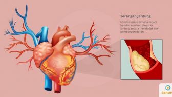 Usia Pasien Serangan Jantung di Indonesia Rata-rata 57 Tahun, Amerika atau Eropa antara 60-65 tahun