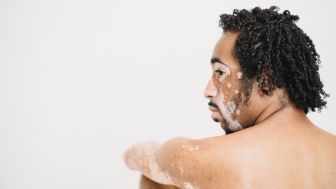 Paparan Vitiligo Terbanyak di Usia Dibawah 20 Tahun dan Anak