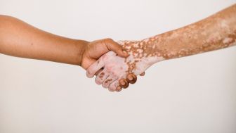 Vitiligo, Salah Satu Penyakit Tertua di Dunia Selain Lepra