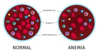 1,7 Juta Remaja di Jabar Alami Anemia