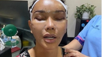 Mirip Amanda Manopo? Rogoh Kocek Rp 1,5 Miliar, Muka Bunda Corla Pasca Oplas Jadi Omongan