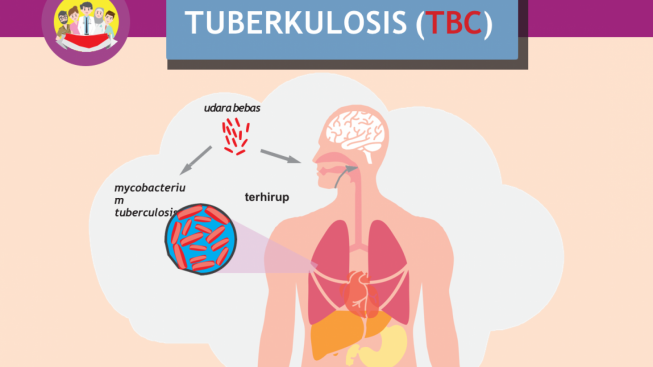 HAM Pasien Penyakit TB Harus Ditegakkan