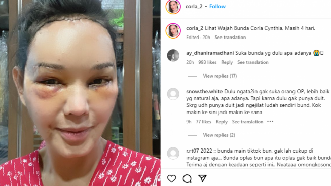 Dulu Bilang Gak Suka Oplas, Bunda Corla Disebut Jilat Ludah Sendiri Usai Permak Wajah