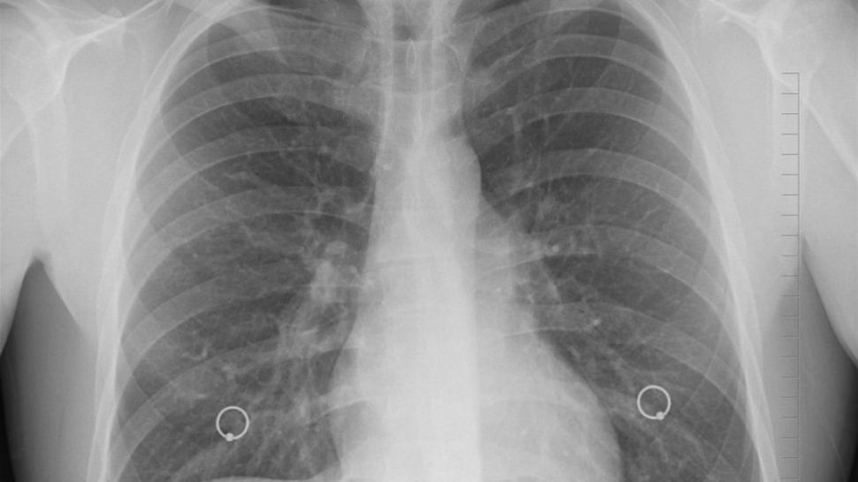 Pneumonia Trigger Infection Called Pneumonia