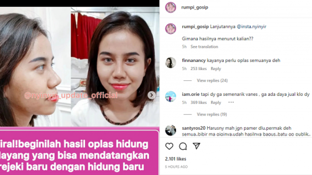 Hasil Operasi Plastik hidung Mayang Lucyana Fitri menuai banyak komentar netizen. [Instagram @rumpi_gosip]